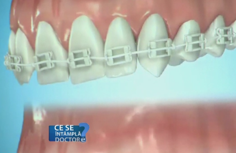 Dintii corect aliniati va scutesc de carii si parodontoza. Cele trei conditii esentiale care mentin dantura sanatoasa