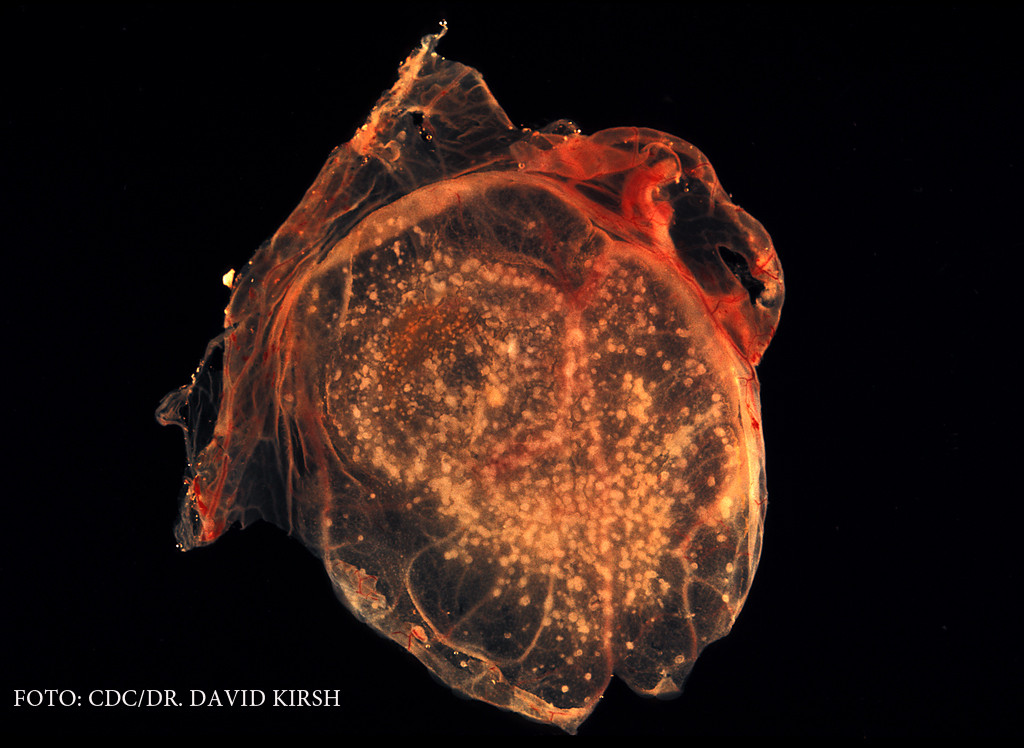 Epidemia care ar putea ajunge foarte curand in Romania. Nu exista vaccin in UE, iar riscul este "imediat"