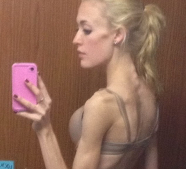 Transformarea spectaculoasa a unei tinere care ajunsese la un pas de moarte din cauza anorexiei. Cum arata dupa recuperare