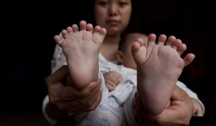 China: un baiat s-a nascut cu 31 de degete la maini si picioare