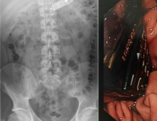 Ce au gasit gardienii in stomacul unui detinut dintr-o inchisoare irlandeza. L-au dus de urgenta la spital