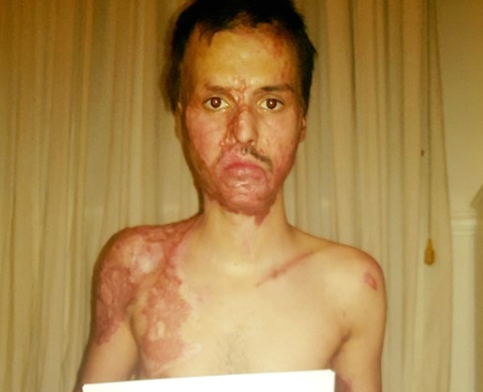 Olteanu Alexandru, ranit in incendiul din Colectiv, a intrat in greva foamei dupa ce mama sa i-ar fi luat toti banii