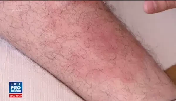 Zeci de bucuresteni au ajuns la spital, muscati de capuse. Medicii spun cum ne putem apara de atacul insectelor