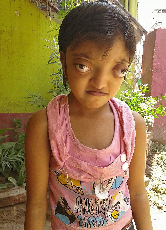 "Copiii si adultii se sperie si o iau la fuga cand o vad". Boala bizara din cauza careia fetita este strigata "broasca"