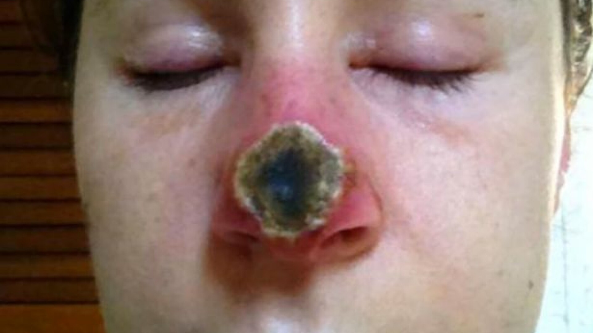 A folosit un remediu natural pentru a scapa de cancerul de piele, dar rezultatele sunt infioratoare. Cum arata acum. FOTO