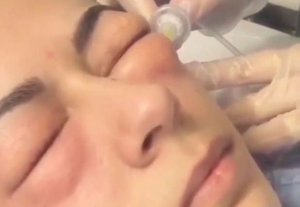 Tratamentul bizar la care recurg femeile pentru a scapa de cearcane. Injectiile care le "umfla" ochii. VIDEO