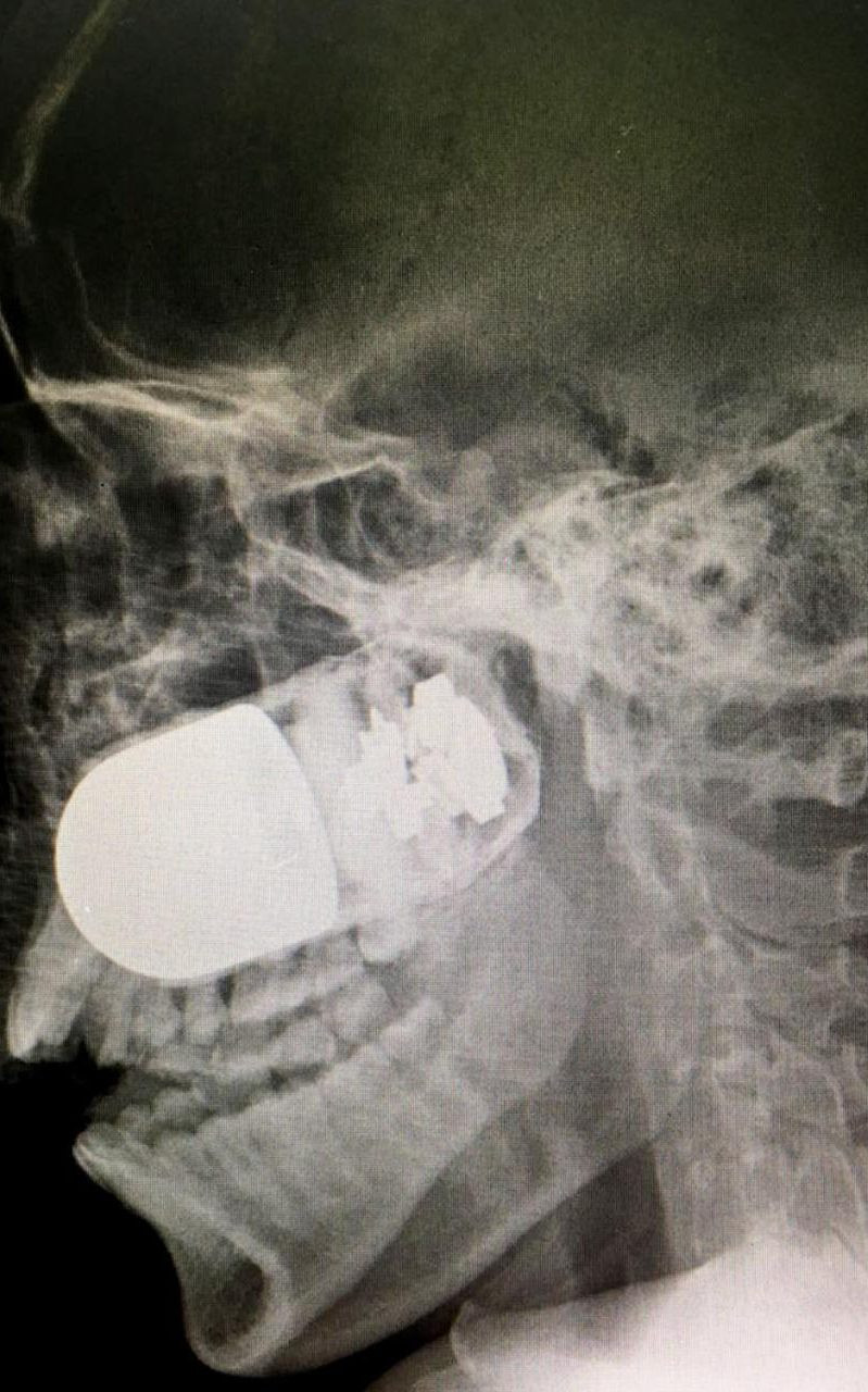 Medicii i-au facut o radiografie unui soldat si au declansat imediat alerta. Ce au descoperit cand s-au uitat pe film