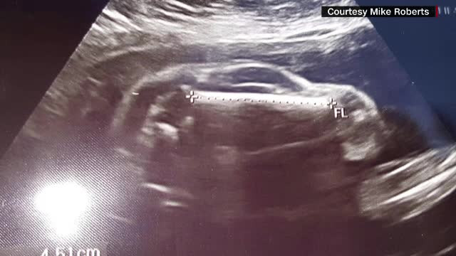 Surpriza pe care au avut-o doi parinti din SUA cand si-au vazut copilul la ecografie. FOTO