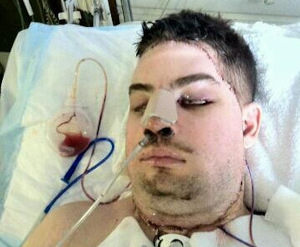 Transplant de fata pentru un soldat care a trecut printr-un accident oribil. Cum arata acum tanarul