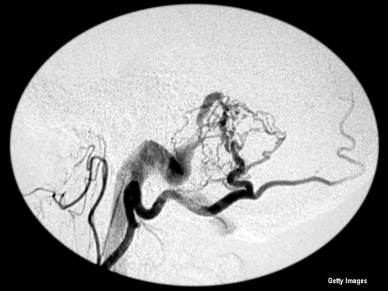 Femeia care risca sa moara daca se enerveaza. Boala de care sufera a transformat-o intr-o "bomba cu ceas"