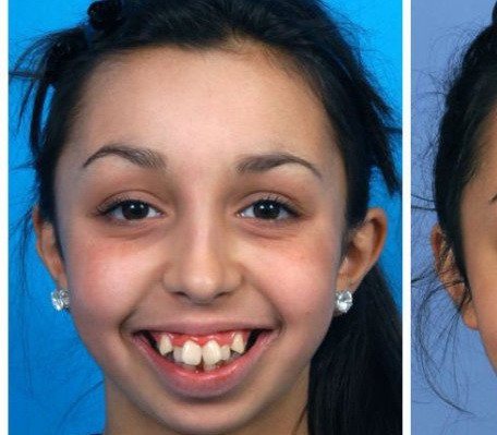 Incredibila transformare suferita de aceasta tanara dupa ce si-a operat maxilarul. Acum este de nerecunoscut