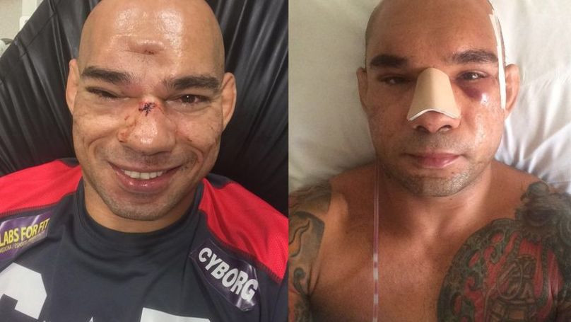 Soldat Universal. Luptatorul care s-a ales cu craniul fracturat in cusca de MMA a fost operat. Cum arata acum