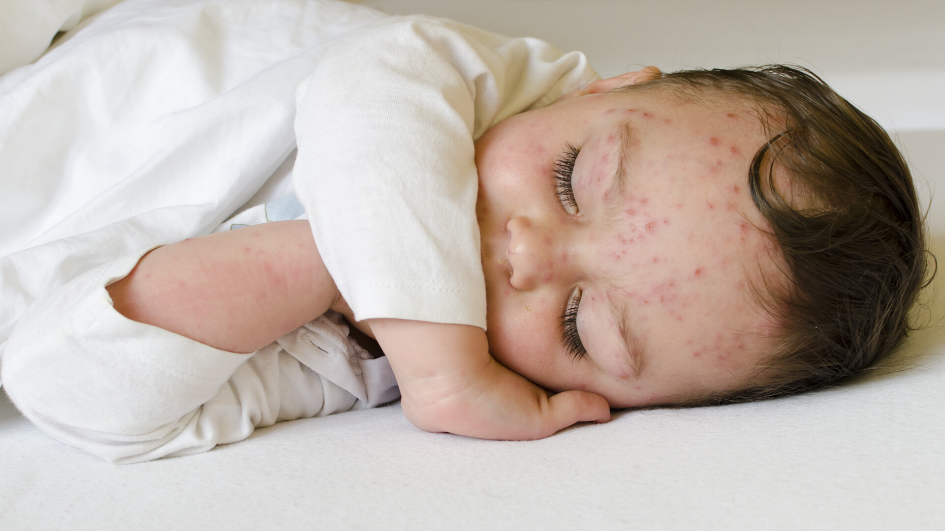 Copilul cu cea mai grava forma de varicela. Ce i-au spus medicii, initial, mamei baietelului de 2 ani