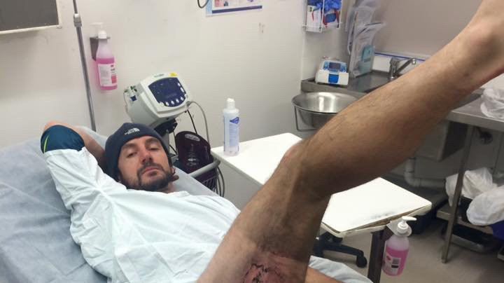 Un ciclist s-a ales cu arsuri de gradul III dupa ce i-a luat foc telefonul iPhone, in buzunar. Ce s-a intamplat. FOTO