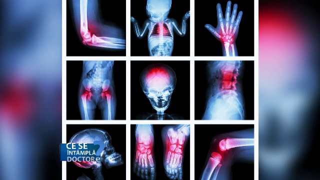 Singurul tratament eficient in cazul monturilor este operatia. De ce sunt femeile mai predispuse la aceasta afectiune