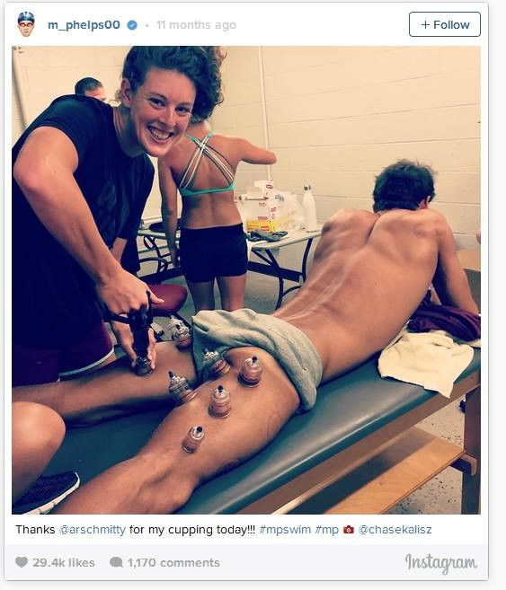 Toata lumea a observat petele rosii de pe spatele lui Michael Phelps! Ce sunt aceste semne