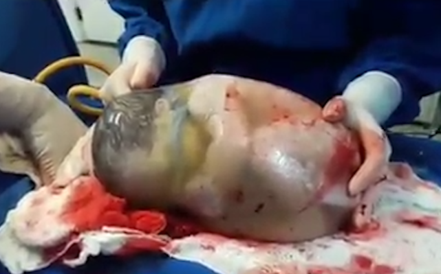 Momentul extrem de rar in care un bebelus se naste in interiorul sacului amniotic intact, filmat de o asistenta medicala