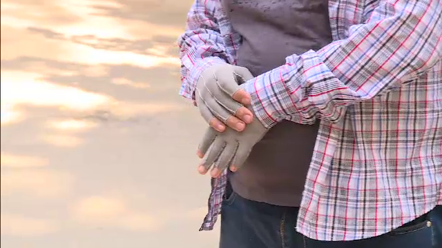 Premiera in sistemul medical romanesc. Tratamentul pacientilor cu arsuri, decontat si dupa externare