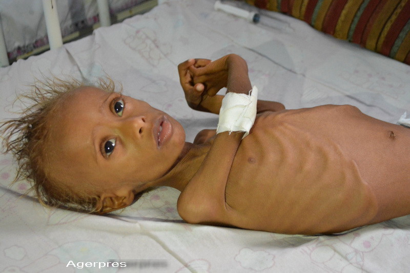 Foamea din Yemen are un chip: Salem are 6 ani si cantareste 4 kilograme. "De cand s-a nascut sufera intruna de foame"