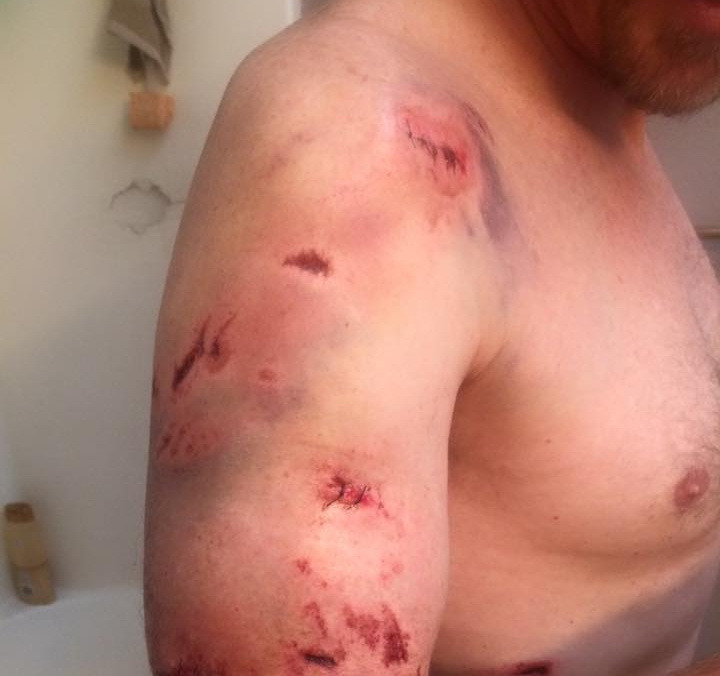 A fost atacat de doua ori de urs, in aceeasi zi, dar a scapat cu viata. Ranile cumplite cu care s-a ales barbatul. FOTO