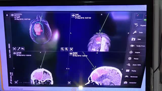 Tehnologia preluata din aviata militara salveaza vieti si in Romania. Cinci pacienti cu tumori pe creier, operati cu succes