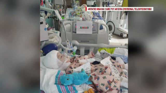 Povestea siamezilor din Chicago, Statele Unite, care s-au nascut lipiti in zona capului. Cum a decurs operatia