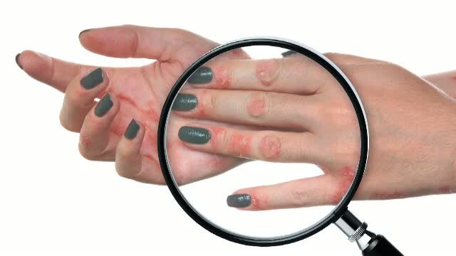 Medicii romani au inregistrat anul acesta 6.000 de cazuri noi de psoriazis. Care sunt cauzele imbolnavirii