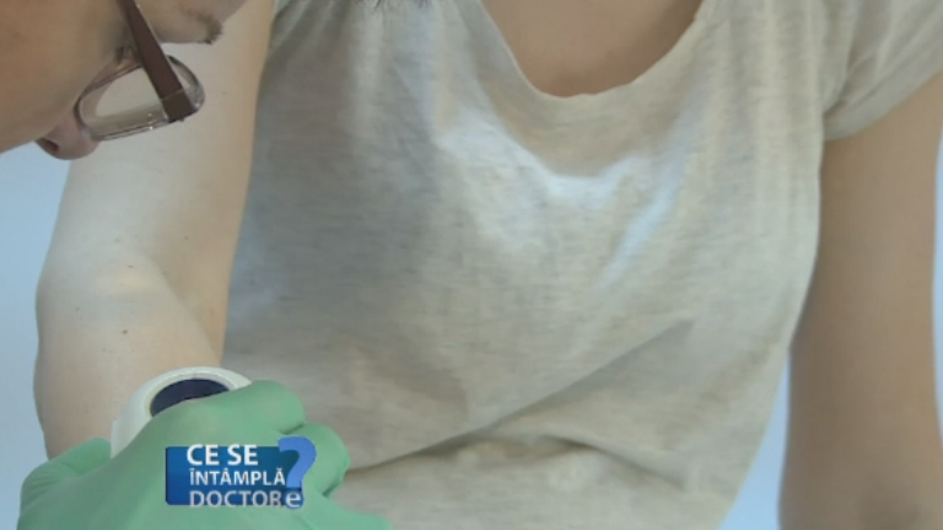 Preconceptiile pacientilor cu privire la alunite. Cum prevenim cancerul de piele