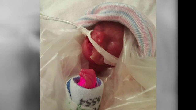 Povestea miraculoasa a baietelului care cantarea doar 425 de grame la nastere. Cum arata dupa 10 luni