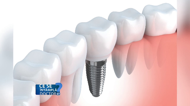 Puteti face o investigatie RMN chiar daca aveti implanturi dentare. Care sunt riscurile de pierdere a unui dinte pus astfel