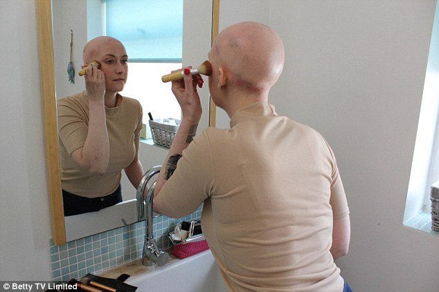 alopecie