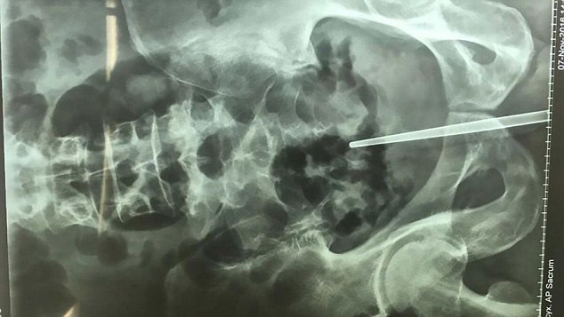 A ajuns de urgenta la spital dupa ce a incercat sa faca pe doctorul acasa. Ce au descoperit medicii la radiografie