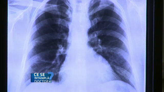 Faceti anual o radiografie la plamani. "Am avut foarte multi pacienti cu cancer pulmonar care au fost tratati de infectii"