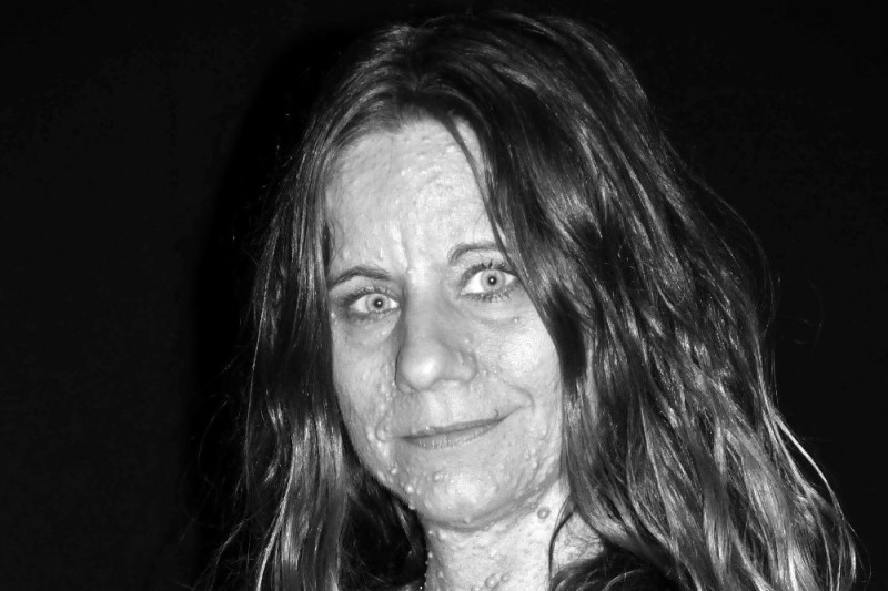 Femeia care are 6.000 de tumori pe piele, raspandite pe tot corpul. Pe langa durerea fizica, ea a fost batjocorita de oameni