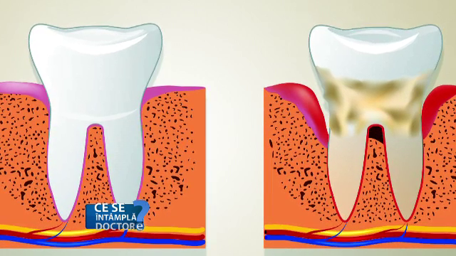 Chiar si cu o igiena temeinica, parodontoza poate aparea. Care sunt cele doua masuri pe care le putem lua pentru preventie