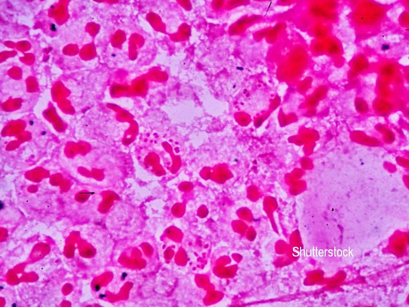 S-a operat la prostata, dar acum nu va mai putea intretine relatii sexuale niciodata. Ce infectie a contactat barbatul