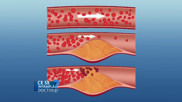 depuneri de grasime pe vasele de sange