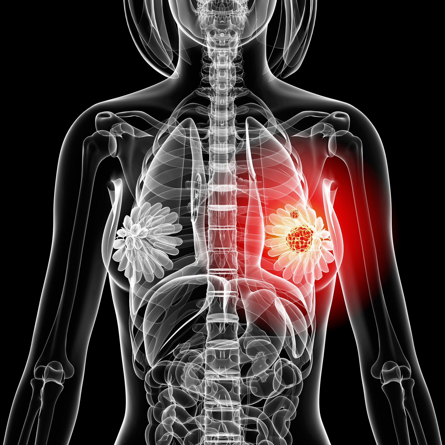 Romancele depistate cu cancer la san raman mutilate pe viata. Cat plateste statul pentru reconstructia mamara