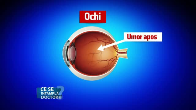 Cum apare tensiunea intraoculara. Contrar confuziei, nu se coreleaza cu cea arteriala
