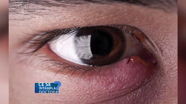 Netratata, o simpla umflatura a ochiului poate genera probleme de vedere. Principalele afectiuni ale pleoapelor