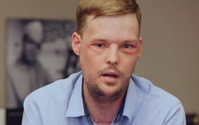 Evolutia remarcabila a unui tanar care s-a impuscat in cap. Andy a primit un transplant de fata in urma cu 8 luni