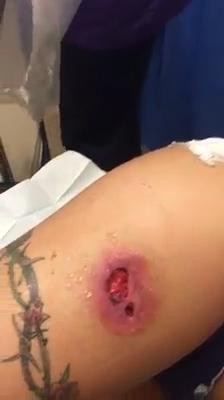 O actrita porno si-a facut singura injectii in picior pentru a se bronza. "Am ramas cu rani imense si cu cicatrice"