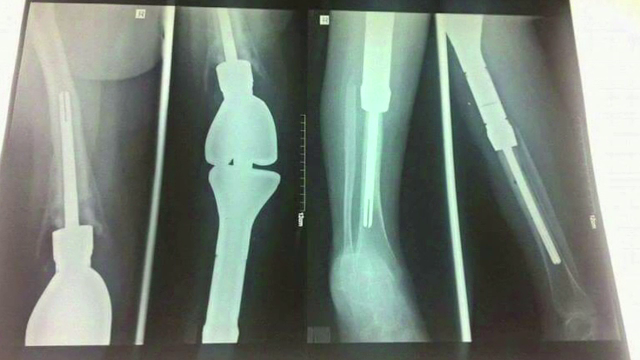 O adolescenta de 16 ani are nevoie de 30.000 de euro, pentru a se trata in Italia. Diagnosticul crunt pe care l-a primit