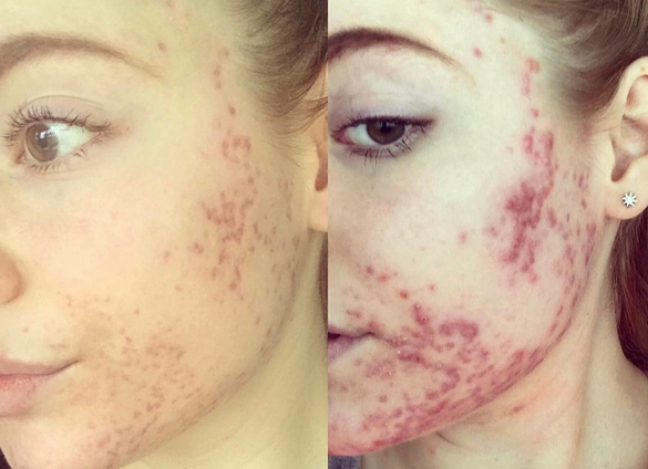 Adolescenta ironizata de tot liceul din cauza acneei este acum in finala unui concurs de frumusetei. Cum arata. GALERIE FOTO