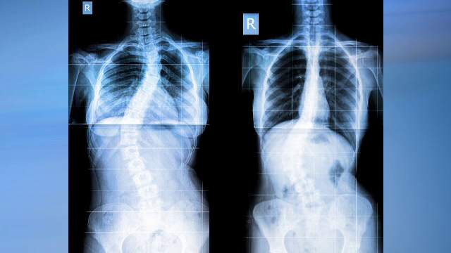 Riscurile la care sunt expusi copiii din cauza pozitiei gresite pe care o au cand folosesc telefoane sau tablete