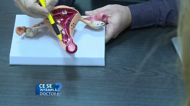 Candidoza are nevoie de un tratament corect pentru ambii parteneri. Care sunt factorii de risc si cum se previne afectiunea