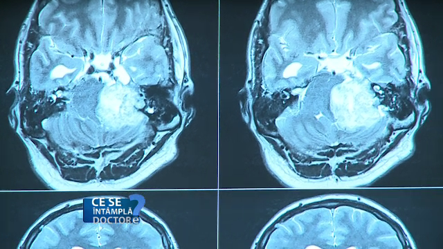 Cum transforma alcoolul materia cenusie din creier in apa. Fenomenul e similar imbatranirii, doar ca mai rapid