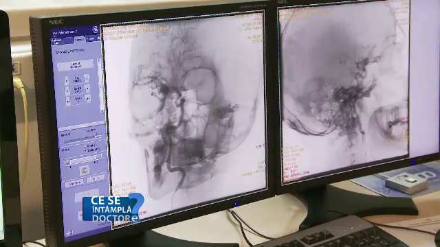Accidentele vasculare cerebrale, care omoara un pacient din doi, sunt agravate de fumat. RMN-ul, prima metoda de preventie