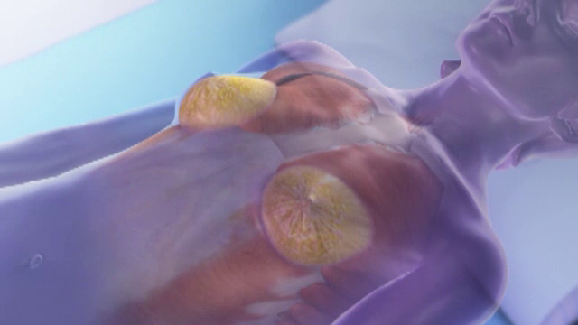 Sute de cazuri de cancer diagnosticat la femei care au implanturi mamare. Semnalul de alarma tras de autoritatile din SUA