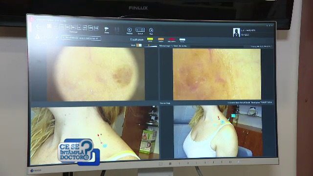 De ce este util sa va faceti selfie daca aveti alunite. Ce informatii transmit dermatologului fotografiile